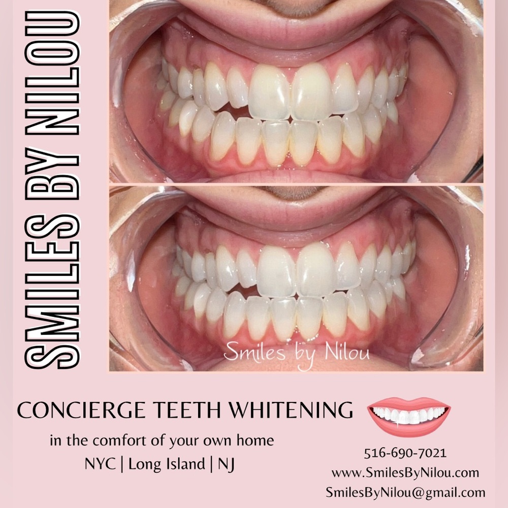 NYC and Long Island concierge teeth whitening